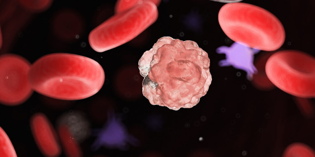 Chłoniak grudkowy oraz DLBCL – priorytety refundacyjne w hematologii w 2023 roku