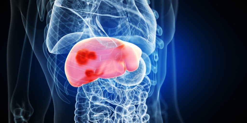 Czwarty filar leczenia nowotworów – radiologia interwencyjna