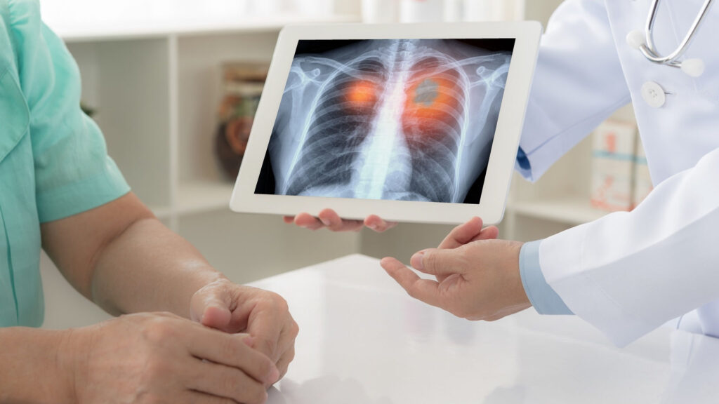 Nowe metody leczenia raka płuca – rosną szanse medycyny w walce z tym nowotworem