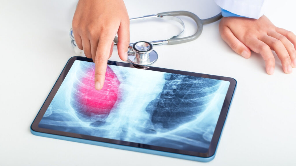 Wczesna profilaktyka, standardy diagnostyczne, większa dostępność do badań molekularnych, wdrożenie Lung Cancer Unit i dostęp do innowacyjnych terapii – kluczem do zmniejszenia śmiertelności z powodu raka płuca