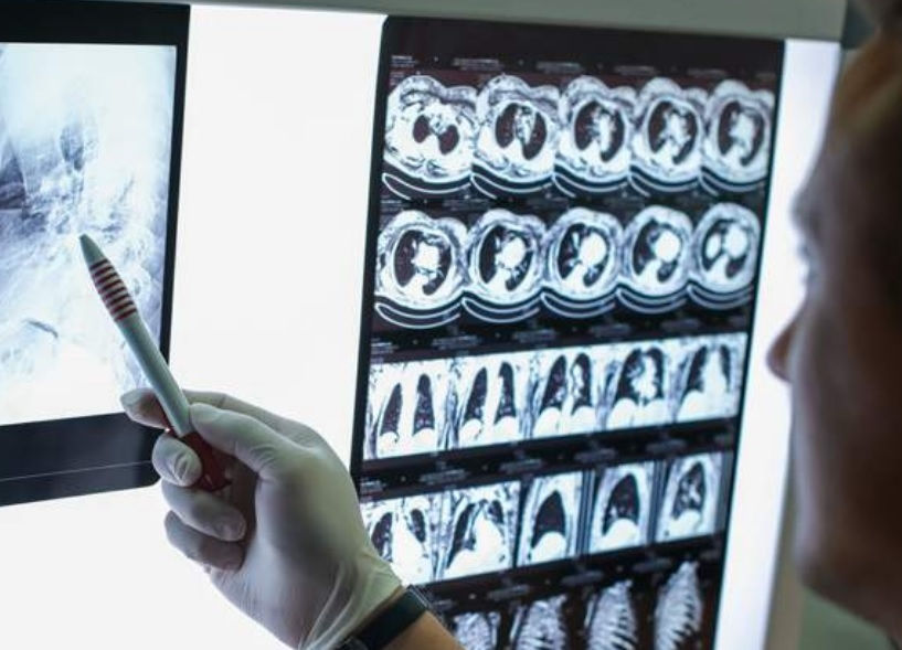 Rak płuca nie poczeka – wyzwaniem przyspieszenie diagnostyki i leczenia chorych