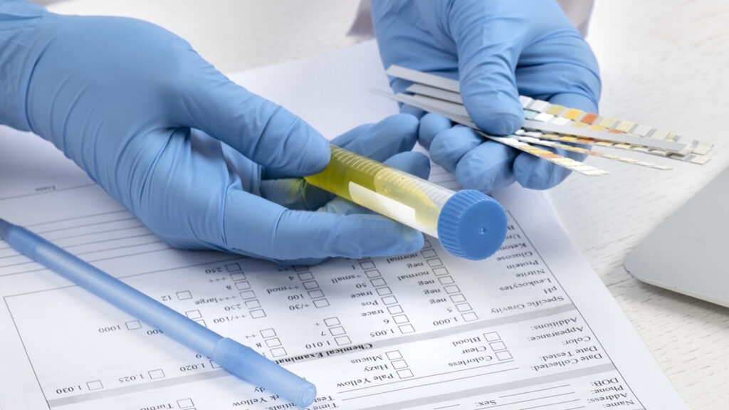 Prosty test moczu może zrewolucjonizować wczesne wykrywanie raka prostaty
