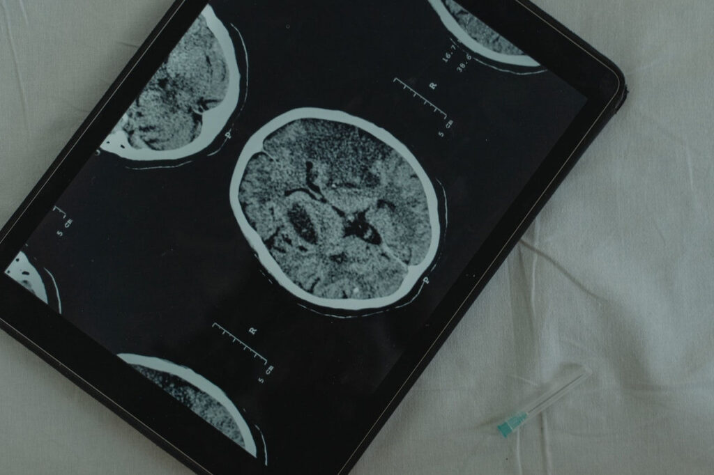 Światowy Dzień Mózgu:  aby lepiej leczyć choroby mózgu, konieczne są inwestycje w neurologię