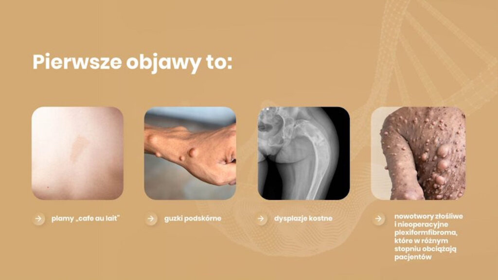„Ludzie boją się podać rękę, odwracają wzrok na ich widok…” 17 maja – Światowy Dzień Neurofibromatoz