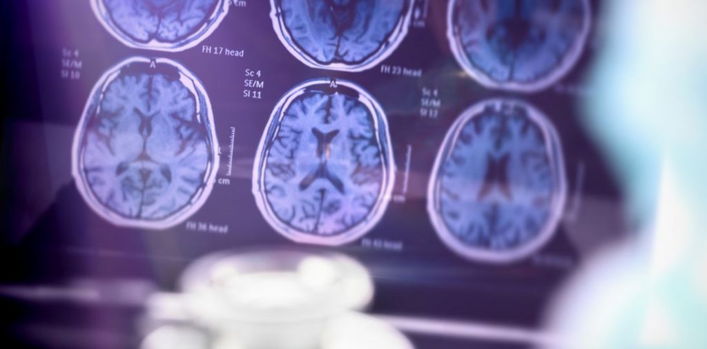 Neurolog: konieczne są zmiany systemowe, które pozwolą wcześniej diagnozować chorobę Alzheimera