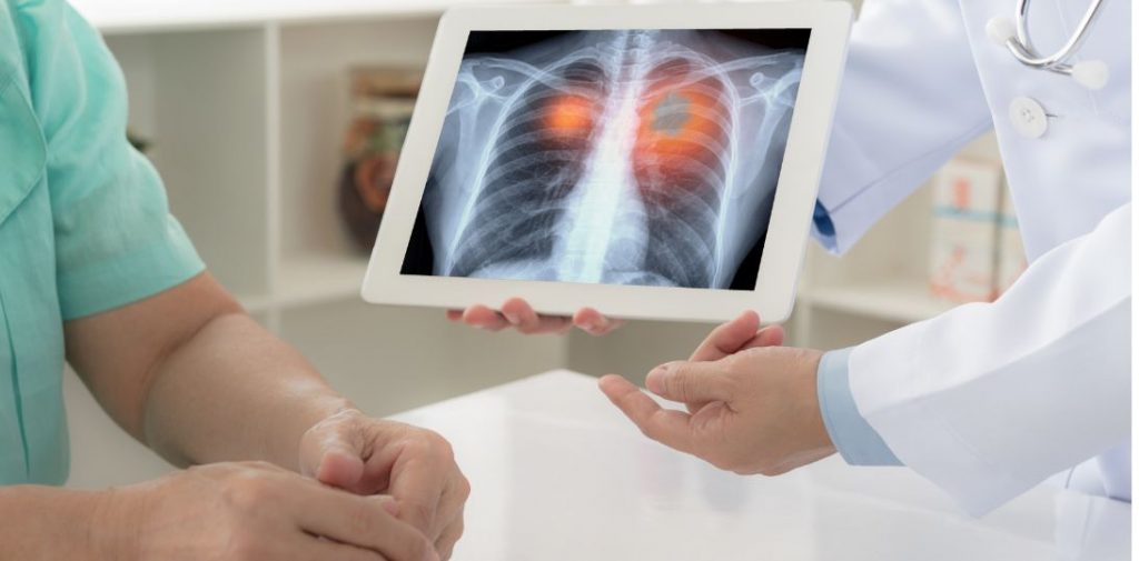 Bezpłatna tomografia płuc od 1 października. Kto skorzysta z programu wczesnego wykrywania raka płuca?