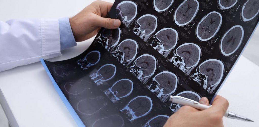 Nowoczesne leczenie ALS zaczyna się od diagnostyki genetycznej. Problemem są zbyt długie kolejki