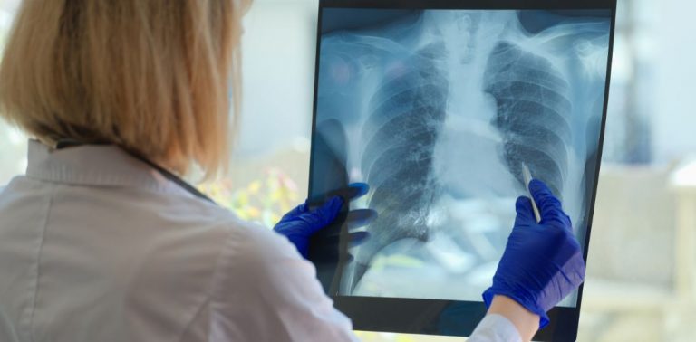 POChP: niemal 60 proc. pacjentów czekało na diagnozę ponad rok. Terapie biologiczne nadal bez refundacji w Polsce