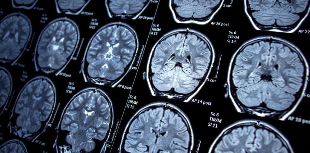 Przełom w leczeniu lekoopornej epilepsji coraz bliżej. Stereo-EEG może trafić do koszyka świadczeń NFZ